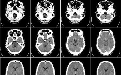 黑白脑扫描网格人脑计算机剖析 从头骨底部到顶部