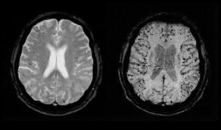 两次脑部扫描，一个看似健康，一个患有老年痴呆症