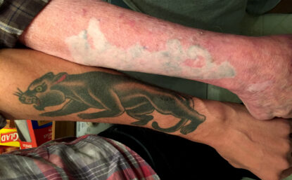 照片双臂一只豹纹身 另一只有动物形状的疤看起来像纹身已被清除